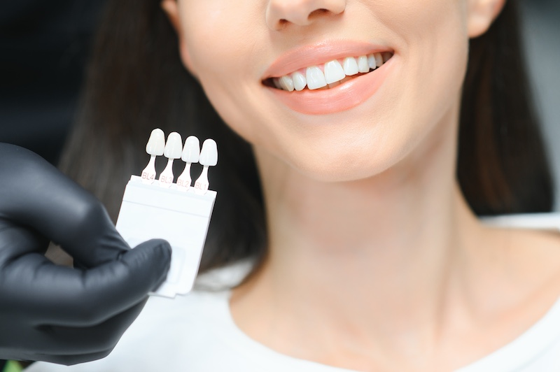 Dental veneers in Glenview