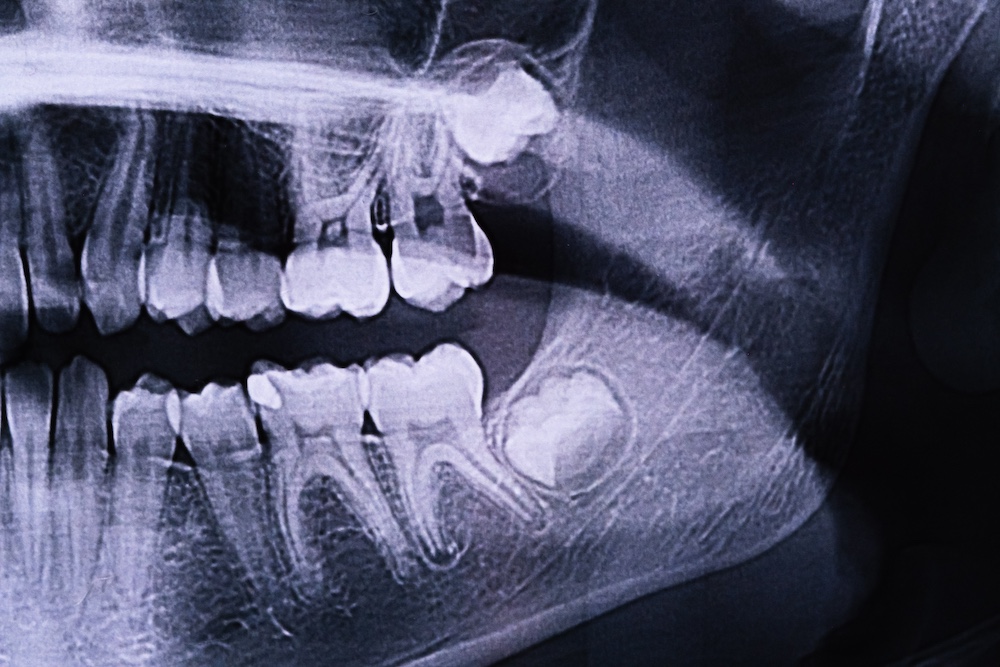 Glenview wisdom teeth extraction